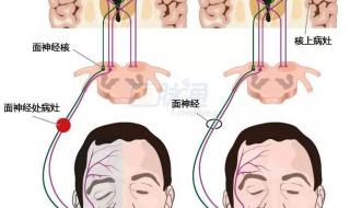 女子被冷风吹成面瘫
