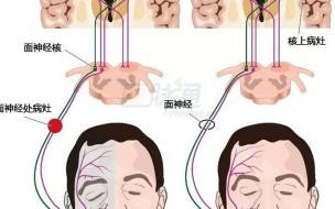 江苏女子回家路上被冷风吹成面瘫,预防面瘫的方法有哪些 女子被冷风吹成面瘫